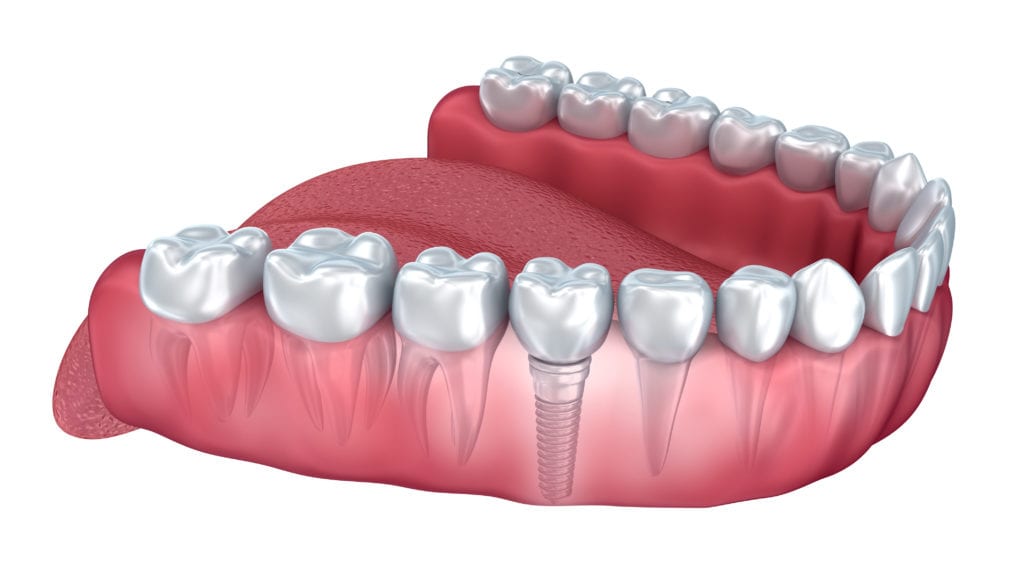 Dental Prosthetic