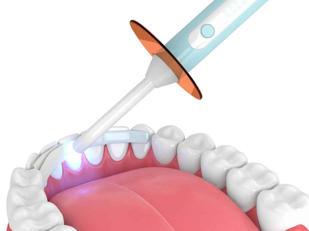 3d render of jaw with dental bonding lamp and dental fiber over white background.