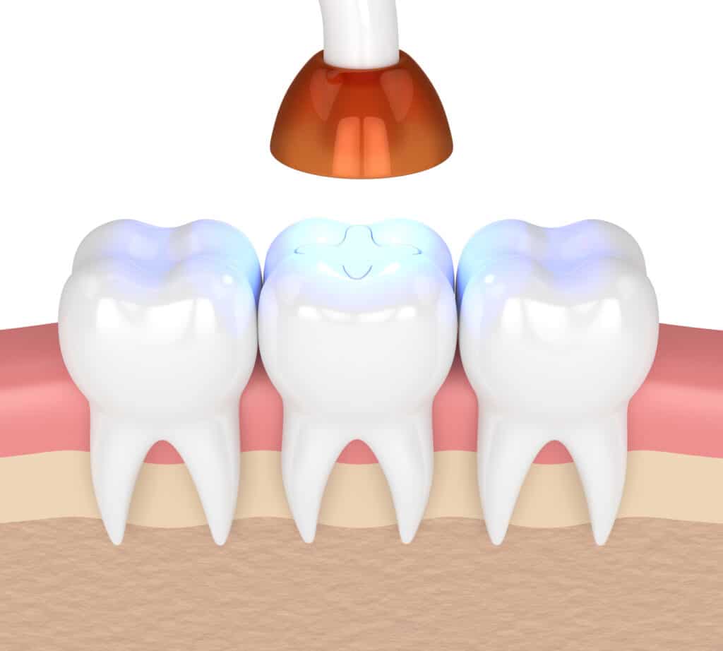 3d render of teeth with dental bonding lamp & light cured inlay filling over white background.