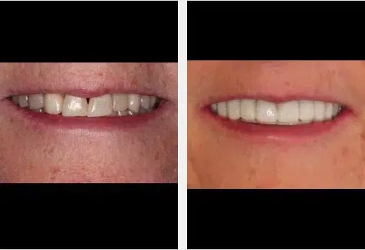 teeth before and after smile makeover whiter and straighter after treatment