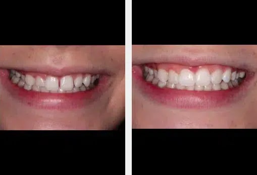 Discolored Tooth Filling, Annapolis Specialist for Restoring Your Dental  Aesthetics