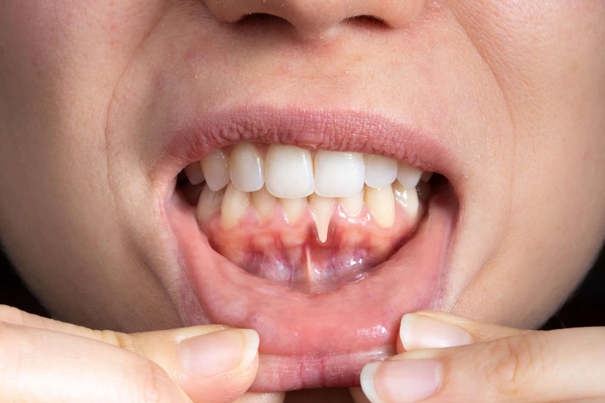 Macro,Of,A,Female,Mouth,With,Receding,Gums.,Close up,Of