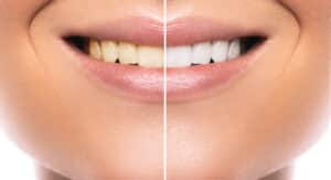 Before and after close-up of a woman's smile, showing how her teeth got whiter after professional whitening treatment.
