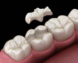 Illustration of a dental inlay which can serve as a possibly stronger alternative to fillings