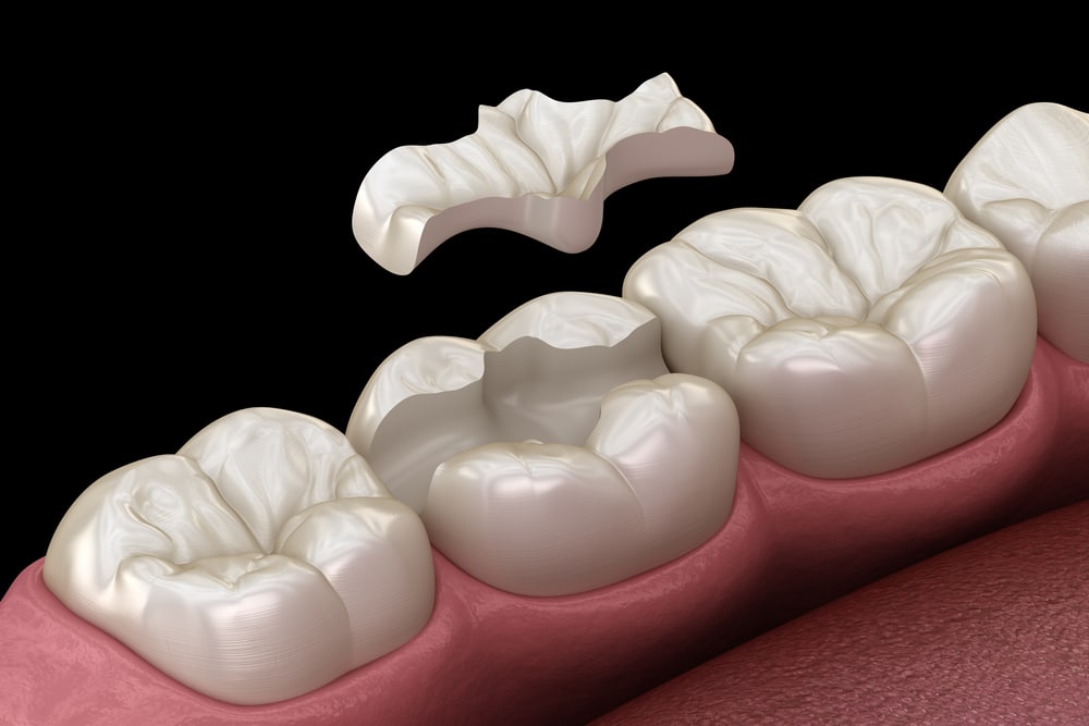 Illustration showing what a dental inlay is and how it is positioned to correct moderate dental issues