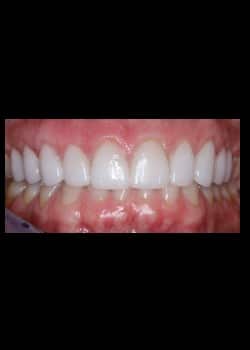 Porcelain Veneers