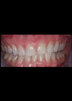 Porcelain Veneers