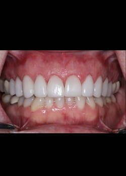 Porcelain Veneers