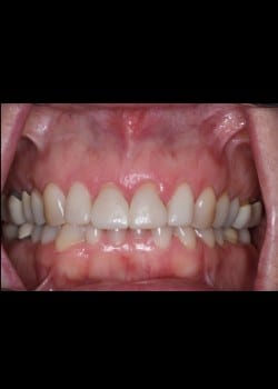 Porcelain Veneers