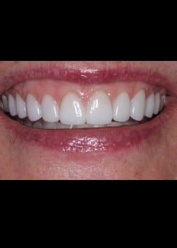 Porcelain Veneers