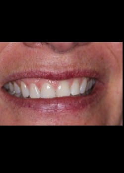 Porcelain Veneers