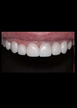 Porcelain Veneers