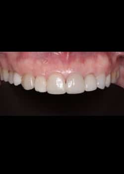 Porcelain Veneers