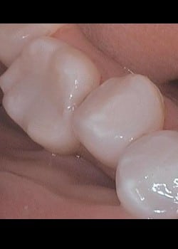 Tooth Colored Filling