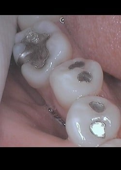 Tooth Colored Filling