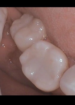 Tooth Colored Filling