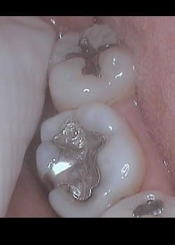 Tooth Colored Filling