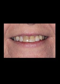 New You Dentures