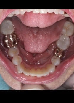 Invisalign