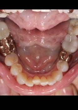 Invisalign