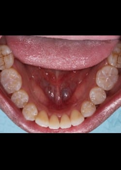 Invisalign