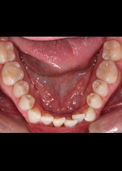 Invisalign